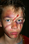 SPFX scars and bruises